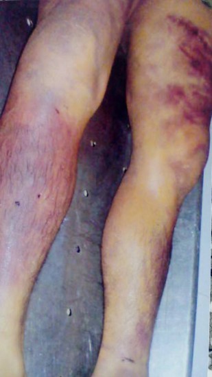 Trên thân thể bị hại Ngô Thanh Kiều có rất nhiều vết cháy do dùi cui điện chích gây ra, nhưng chưa được điều tra làm rõ.
